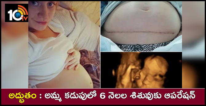 అద్భుతం : అమ్మ కడుపులో 6 నెలల శిశువుకు ఆపరేషన్