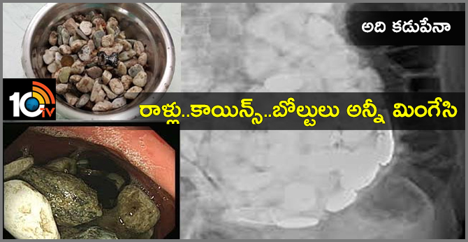 54-year-old man eating coins, stones.bottle caps to cure anxiety in korea