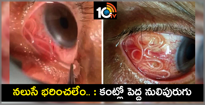 OMG! Worm Was Removed From Woman's Eye!