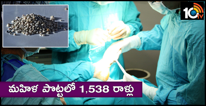 మహిళ పొట్టలో 1,538 రాళ్లు మహిళ పొట్టలో 1,538 రాళ్లు