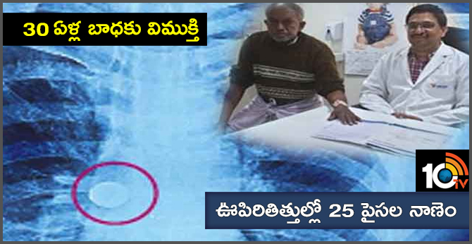 30 ఏళ్ల బాధకు విముక్తి : ఊపిరితిత్తుల్లో 25 పైసల నాణెం 30 ఏళ్ల బాధకు విముక్తి : ఊపిరితిత్తుల్లో 25 పైసల నాణెం