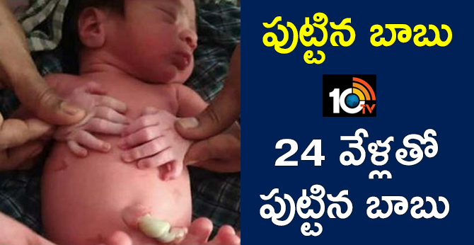 Baby Boy Born With 24 Fingers at Aluru  Jogulamba Gadwal Dist