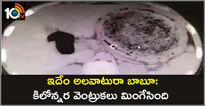 'Pica' effect :  8-year-old girl complains of severe stomachdoctors discover 1.5 kg hairball in her belly
