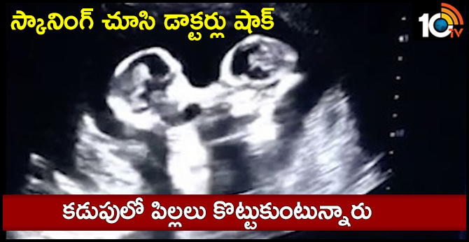 స్కానింగ్ చూసి డాక్టర్లు షాక్ : కడుపులో పిల్లలు కొట్టుకుంటున్నారు స్కానింగ్ చూసి డాక్టర్లు షాక్ : కడుపులో పిల్లలు కొట్టుకుంటున్నారు
