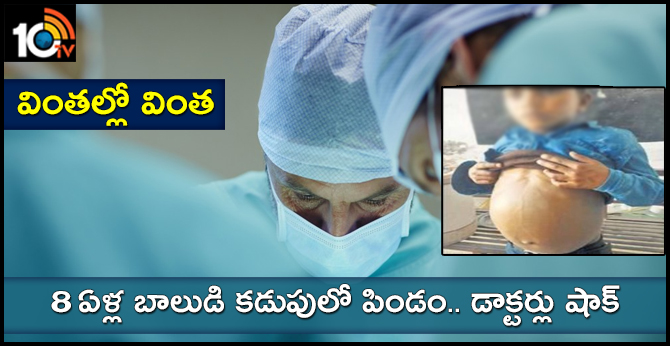 Rajasthan, an embryo of 3 kg of an 8 year-old child came out of the stomach