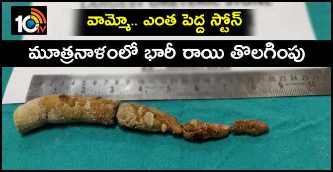 World's largest ureteric stone removed by surgery in Delhi