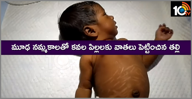 మూఢ నమ్మకాలతో కవల పిల్లలకు వాతలు పెట్టించిన తల్లి మూఢ నమ్మకాలతో కవల పిల్లలకు వాతలు పెట్టించిన తల్లి