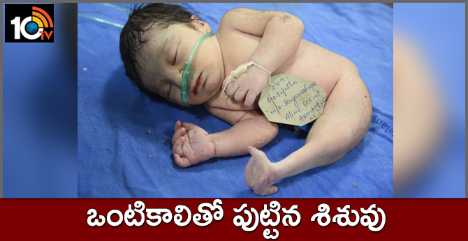 ఒంటికాలితో పుట్టిన శిశువు ఒంటికాలితో పుట్టిన శిశువు