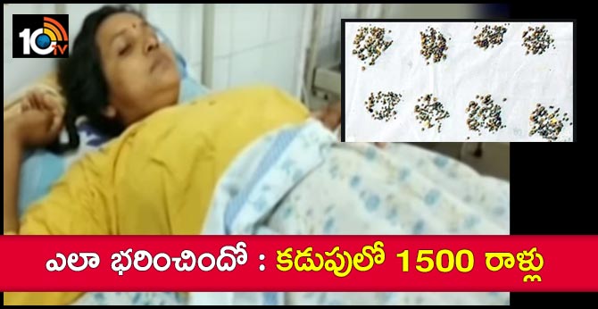 1,500 stones removed from woman’s Stomach