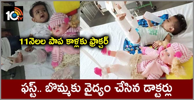 To Treat 11-Month-Old's Fracture, Doctors First Had To Plaster Her Doll