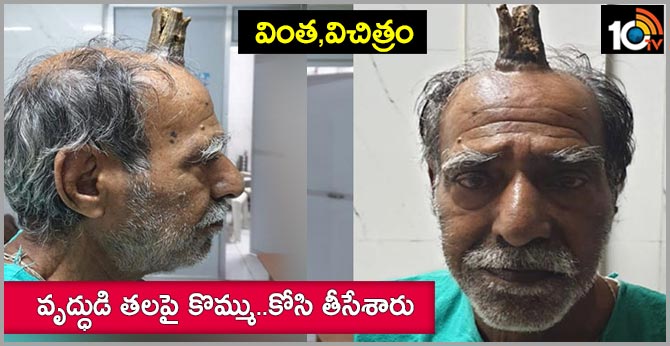 74-year-old Madyapradesh Shyam Lal Yadav grows devil’s horn after injury
