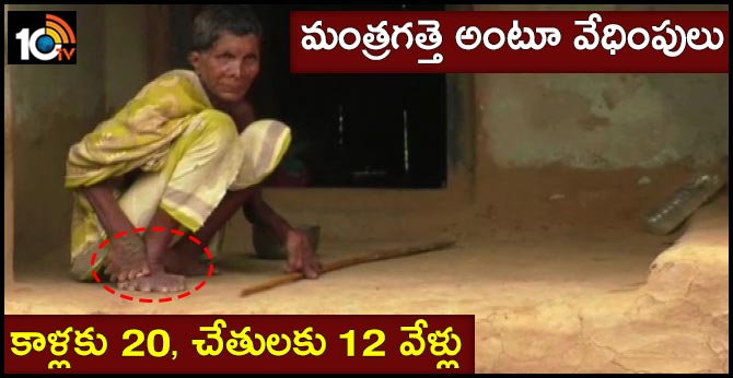 65-year-old Odisha woman  born with 12 fingers&20 toes...woman witch forced indoors