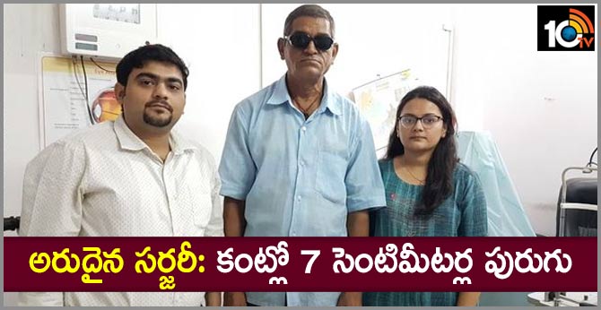 అరుదైన సర్జరీ: కంట్లో 7 సెంటిమీటర్ల పురుగు అరుదైన సర్జరీ: కంట్లో 7 సెంటిమీటర్ల పురుగు