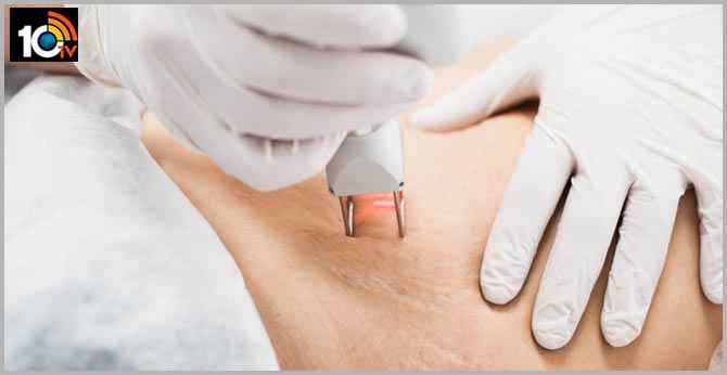 Health Tips: The Truth About Stretch Marks