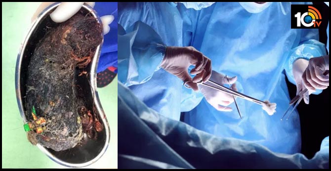 Tamil Nadu doctors remove half kg hair, shampoo sachets from minor girl's stomach