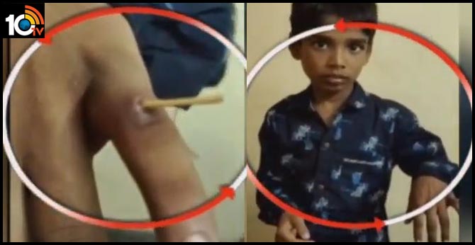 strange disease, quills from boy hand