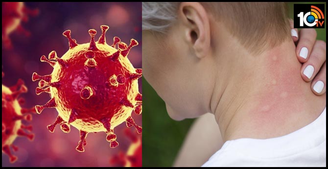 Another unusual symptom FOR coronavirus by french study