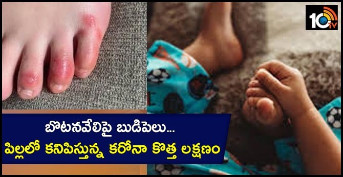 బొటనవేలిపై బుడిపెలు… పిల్లలో కనిపిస్తున్న కరోనా కొత్త లక్షణం బొటనవేలిపై బుడిపెలు… పిల్లలో కనిపిస్తున్న కరోనా కొత్త లక్షణం