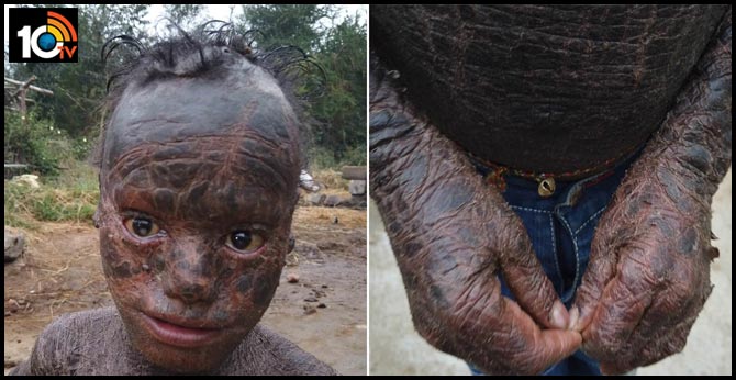 10 year old Odisha boy with rare skin condition sheds his skin every month