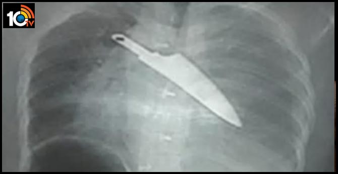 30 hours after stabbing, knife removed from woman's chest