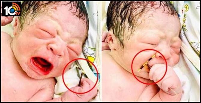 తల్లి IUDని చేత్తో పట్టుకుని పుట్టిన శిశువు తల్లి IUDని చేత్తో పట్టుకుని పుట్టిన శిశువు