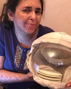 Woman allergic to the sun hasn’t been out in daylight for 20 years without a mask