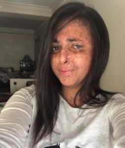 Woman allergic to the sun hasn’t been out in daylight for 20 years without a mask