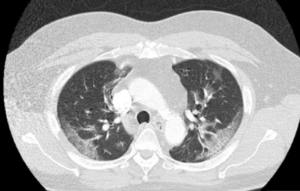 Persistent hiccups could be coronavirus warning sign after man suffered unusual symptom for four DAYS, docs warn