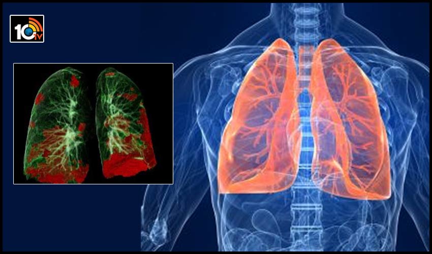 LUNG CAPACITY : కరోనాతో దెబ్బతిన్న ఊపిరితిత్తులు 3 నెలల్లో వాటింతటవే రిపేర్ చేసుకోగలవ్ LUNG CAPACITY : కరోనాతో దెబ్బతిన్న ఊపిరితిత్తులు 3 నెలల్లో వాటింతటవే రిపేర్ చేసుకోగలవ్