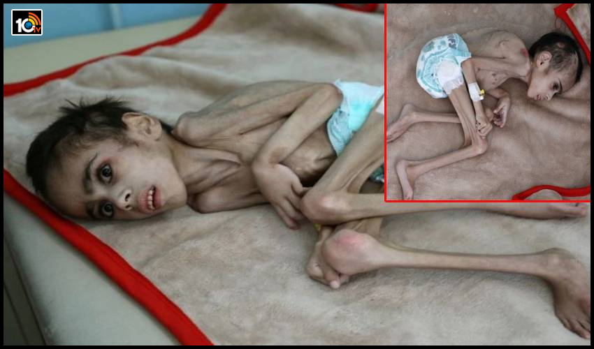 Yemen boy Heartbreaking Photo viral : గుండెలు ద్రవించే ఆకలి కేకలు.. Yemen boy Heartbreaking Photo viral : గుండెలు ద్రవించే ఆకలి కేకలు..