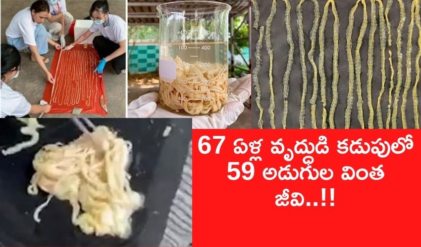 ద్యావుడా?! : 67 ఏళ్ల వృద్ధుడు కడుపులో 59 అడుగుల వింత జీవి..!! ద్యావుడా?! : 67 ఏళ్ల వృద్ధుడు కడుపులో 59 అడుగుల వింత జీవి..!!