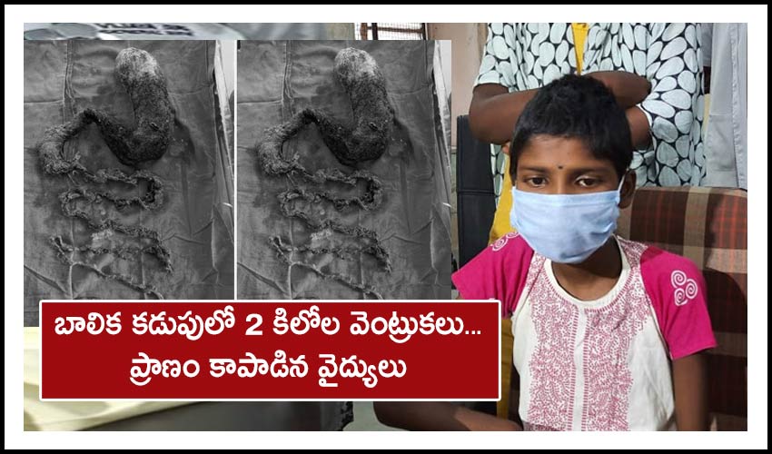 Osmania Doctors Removed 2kg Hairfrom A Girls Stomach