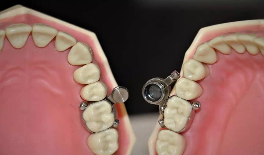 Scientists Develop Weight Loss Device That Locks People’s Jaws Shut (1)