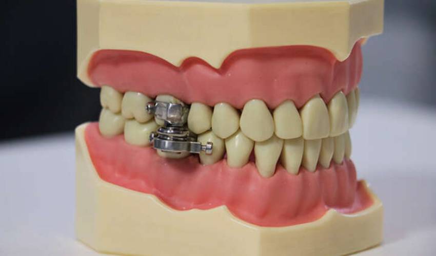Scientists Develop Weight Loss Device That Locks People’s Jaws Shut (2)