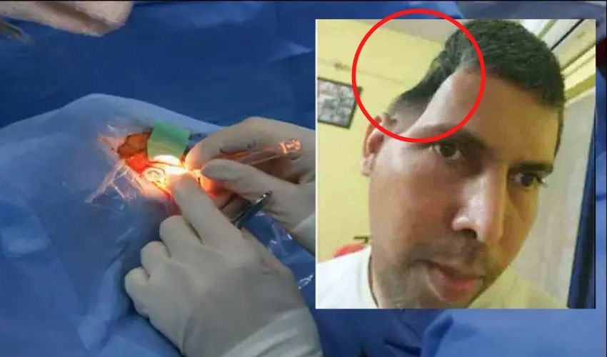 Doctors Remove Man Skull Part During Brain Tumor Surgery