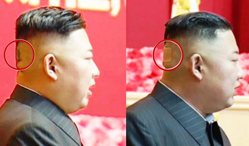 Kim Jong Uns Head Bandage Is Added To List Of Health Mysteries