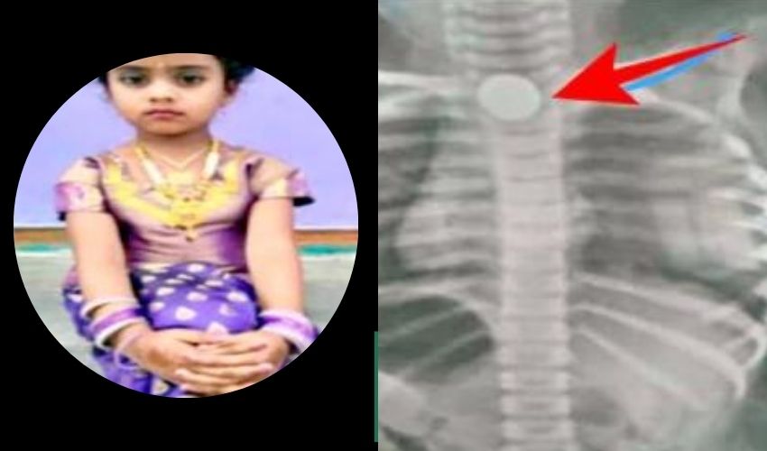 Mysuru : చిన్నారి ప్రాణం తీసిన రూ.5 కాయిన్ Mysuru : చిన్నారి ప్రాణం తీసిన రూ.5 కాయిన్