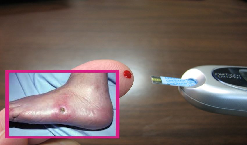 Diabetes : చక్కెర వ్యాధిగ్రస్తులు… చిన్నచిన్న గాయాలను అశ్రద్ధ చేస్తున్నారా?… Diabetes : చక్కెర వ్యాధిగ్రస్తులు… చిన్నచిన్న గాయాలను అశ్రద్ధ చేస్తున్నారా?…