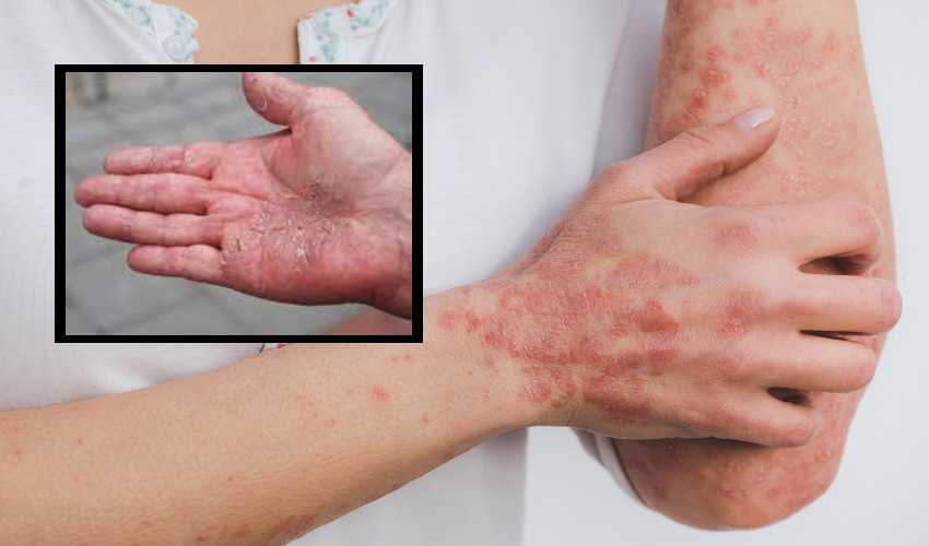 Psoriasis : చర్మానికి సోరియాసిస్ ముప్పు..ఎందుకంటే?.. Psoriasis : చర్మానికి సోరియాసిస్ ముప్పు..ఎందుకంటే?..