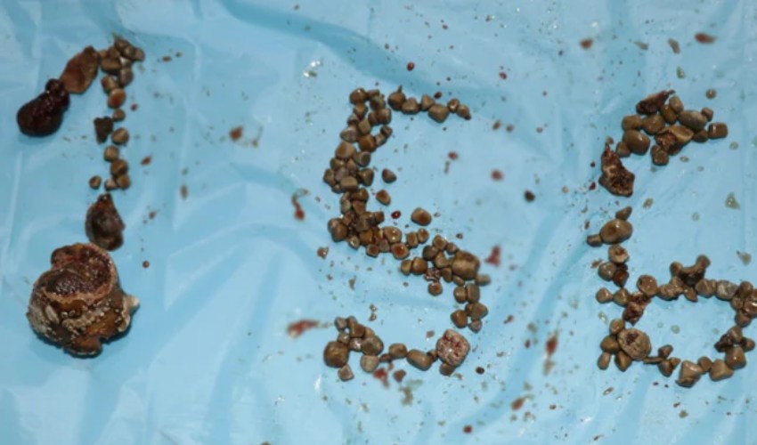 Record 156 Kidney Stones Removed From Single Patient In Hyderabad