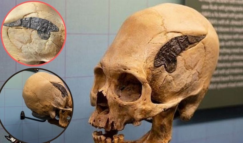2000 Year Old Skull Shows Evidence Of Advanced Surgery