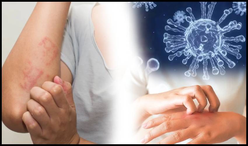 Covid 19 Omicron Symptoms As Skin Rash The New Key Symptom Of Coronavirus Variant, According To Scientists