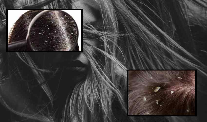 Dandruff : చుండ్రు సమస్య నివారణకు గృహ చిట్కాలు Dandruff : చుండ్రు సమస్య నివారణకు గృహ చిట్కాలు