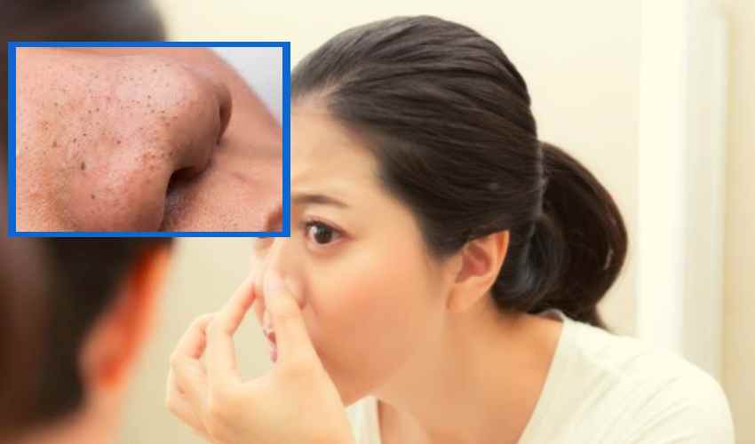 Blackheads : చర్మంపై బ్లాక్ హెడ్స్ తొలగించే చిట్కాలు Blackheads : చర్మంపై బ్లాక్ హెడ్స్ తొలగించే చిట్కాలు