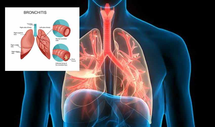 Bronchitis Problem : బ్రాంకైటిస్ సమస్య…జాగ్రత్తలు