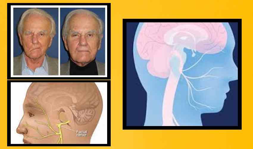 Facial Paralysis : ముఖ పక్షవాతం…లక్షణాలు…కారణాలు Facial Paralysis : ముఖ పక్షవాతం…లక్షణాలు…కారణాలు