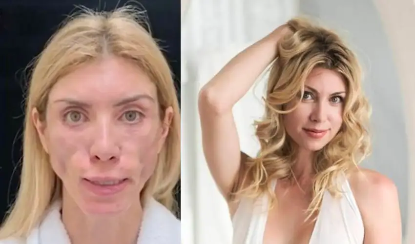 Plastic Surgery: ప్లాస్టిక్ సర్జరీ చేసుకున్న బ్యూటీ క్వీన్.. నవ్వడమే కాదు కళ్లు మూయడానికి కూడా లేదు! Plastic Surgery: ప్లాస్టిక్ సర్జరీ చేసుకున్న బ్యూటీ క్వీన్.. నవ్వడమే కాదు కళ్లు మూయడానికి కూడా లేదు!