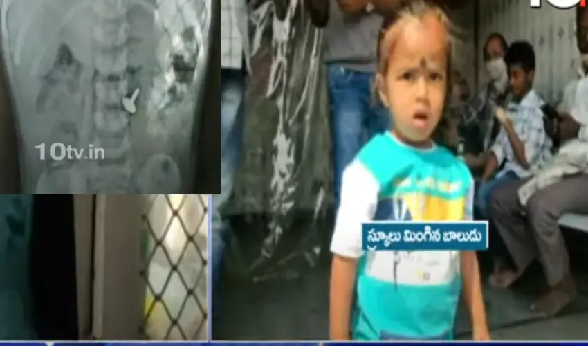 Boy Swallow Screws : తల్లిదండ్రులూ జాగ్రత్త.. ఏడాదిన్నర బాబు కడుపులో స్క్రూలు.. అసలేం జరిగిందంటే.. Boy Swallow Screws : తల్లిదండ్రులూ జాగ్రత్త.. ఏడాదిన్నర బాబు కడుపులో స్క్రూలు.. అసలేం జరిగిందంటే..