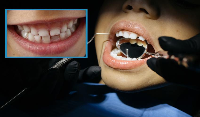 Gap Between Teeth : పిల్లల్లో దంతాల మధ్య గ్యాప్ ఎందుకంటే? Gap Between Teeth : పిల్లల్లో దంతాల మధ్య గ్యాప్ ఎందుకంటే?