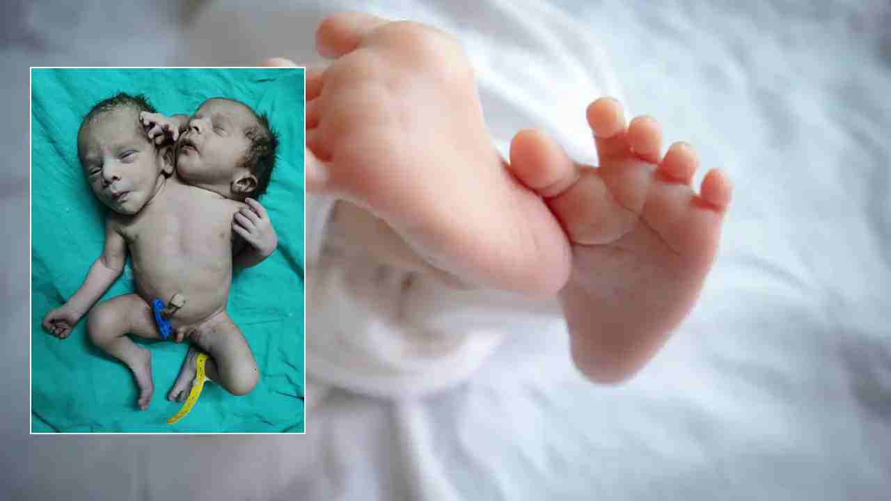 Twin Heads: రెండు తలలు, మూడు చేతులతో శిశువు జననం, తల్లీబిడ్డా క్షేమం Twin Heads: రెండు తలలు, మూడు చేతులతో శిశువు జననం, తల్లీబిడ్డా క్షేమం